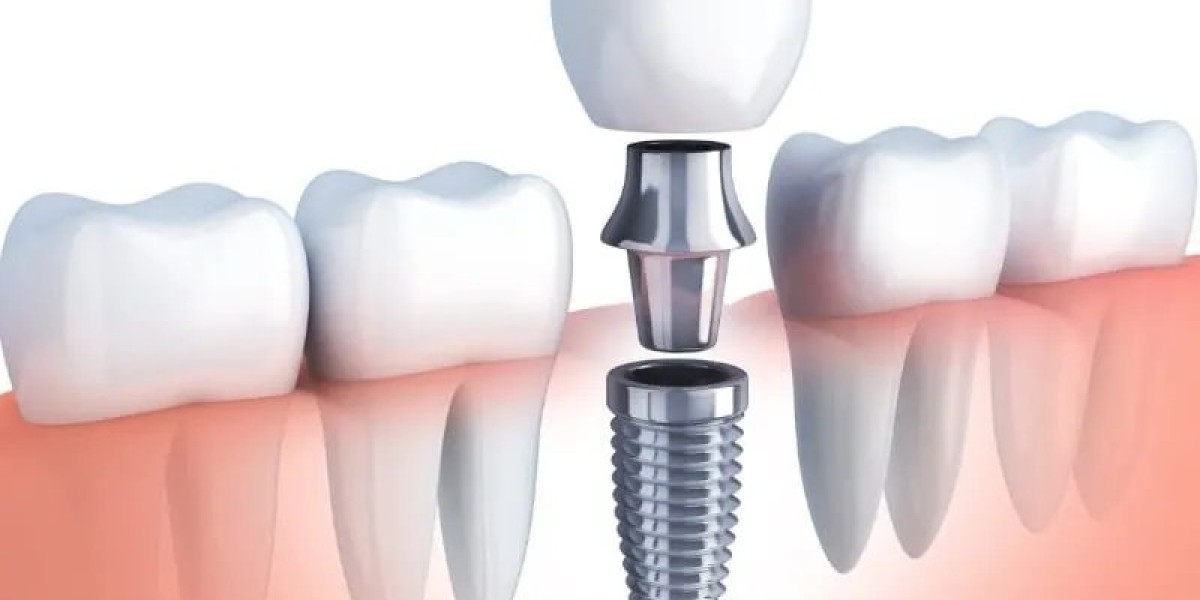 Tooth Replacement: Options, Procedures, and Finding Services in McKinney, Texas